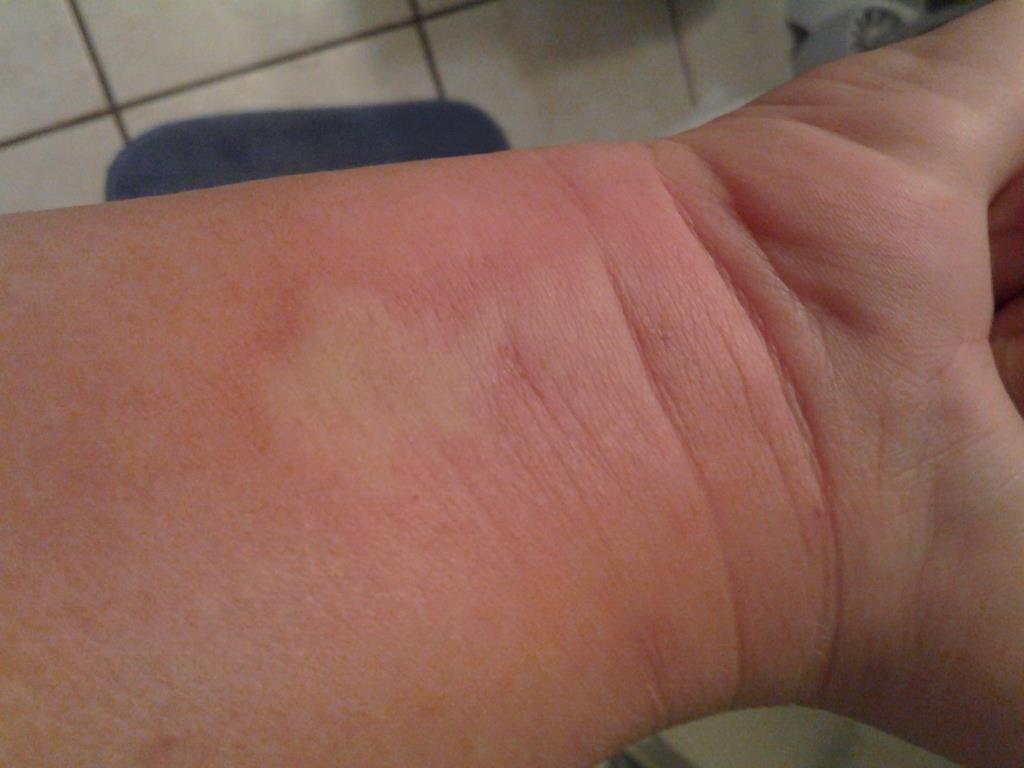 i guess im allergic to bees. the itch refuse to go away