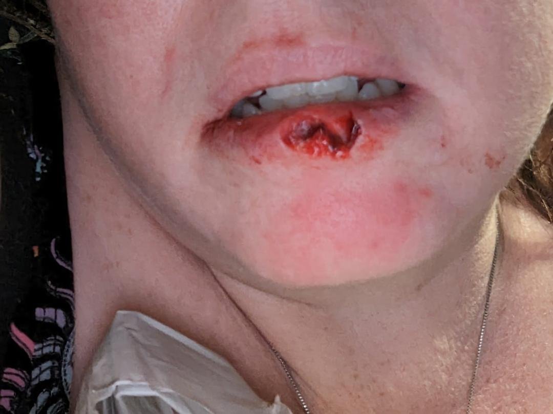 So asking if any medical professionals out there have advice? My dog ripped off part of my lip. I applied pressure, ice, took some ibuprofen and Tylenol. Clean gauze now that bleeding isn't bad. Can this wait to see a Dr? O