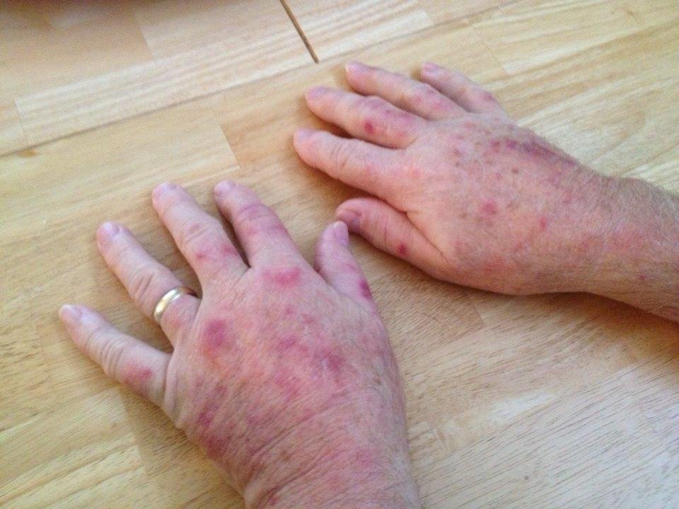 This is what Rocky Mountain Spotted Fever looks like. Yep, Tom has it 

Beware of tick bites!!
