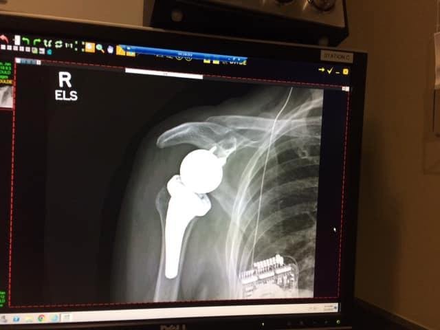 This is my new reversed right shoulder replacement
