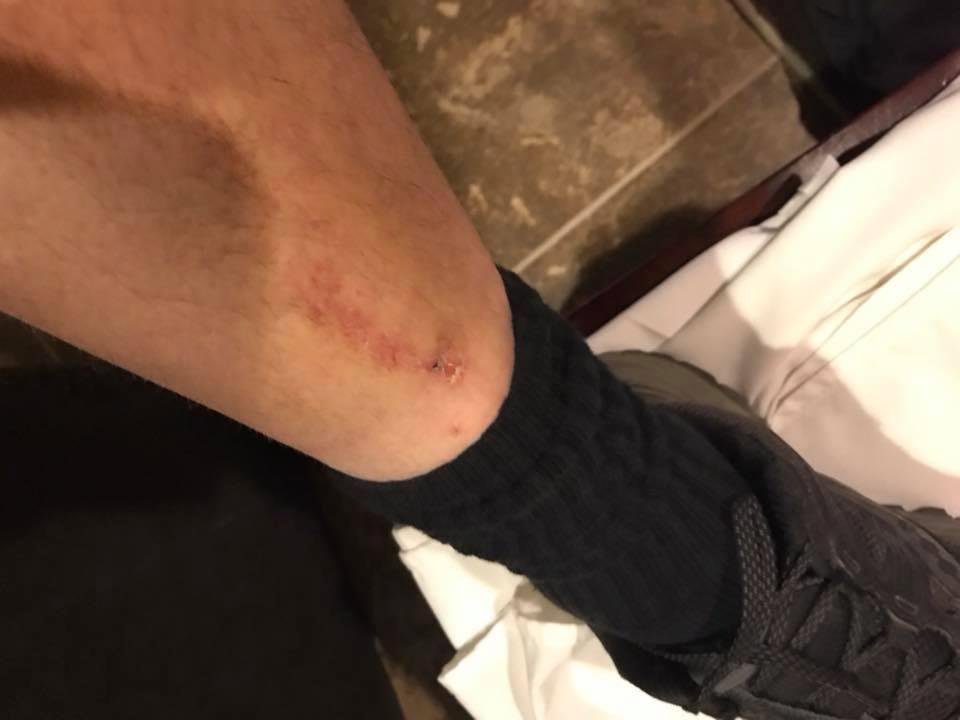 Here is what happens when you miss a shelf sticking out in the aisle at a GameStop on your bad side and your brain is too stubborn to stop your foot from going forward