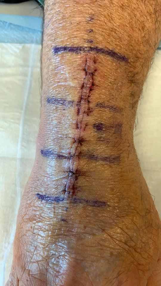 I flexed too hard and my skin tore open - take that Chuck Norris