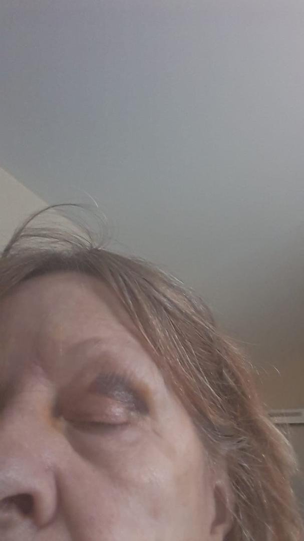 Another owie due to my falling every single day