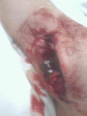 My brother Steve  needs prayers for his recovery...

This is the cut he got yesterday while working around a bushhog mower...

To the people that have to work around this kind of machinery......                  PLEASE   BE