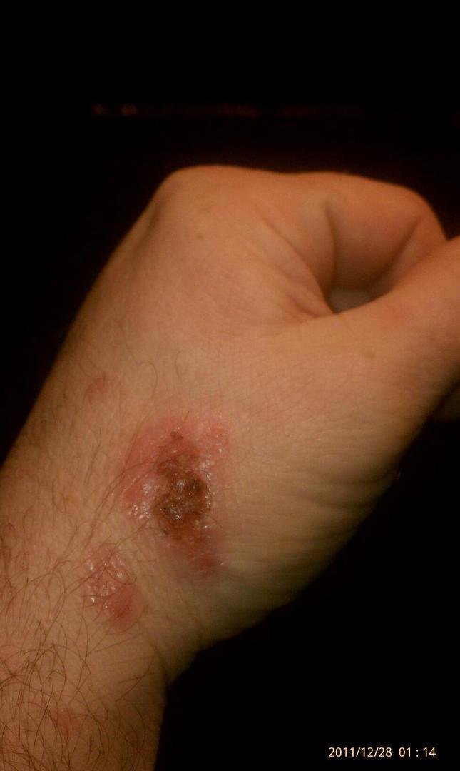 State of NJ burn