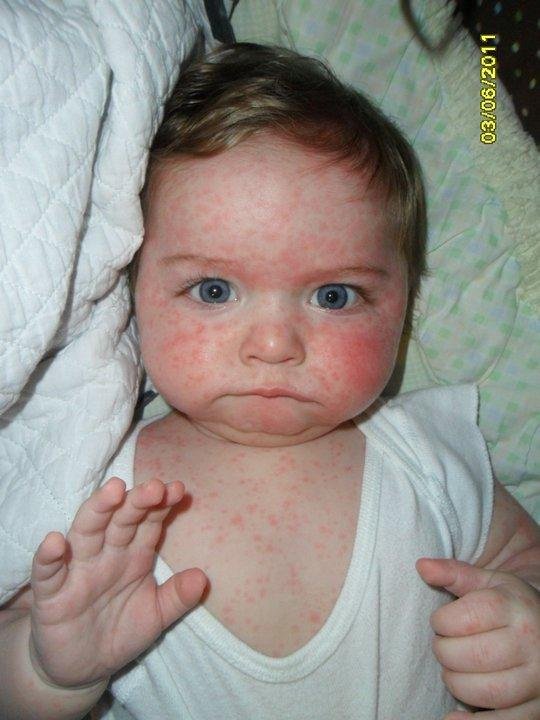 rash from his medicine