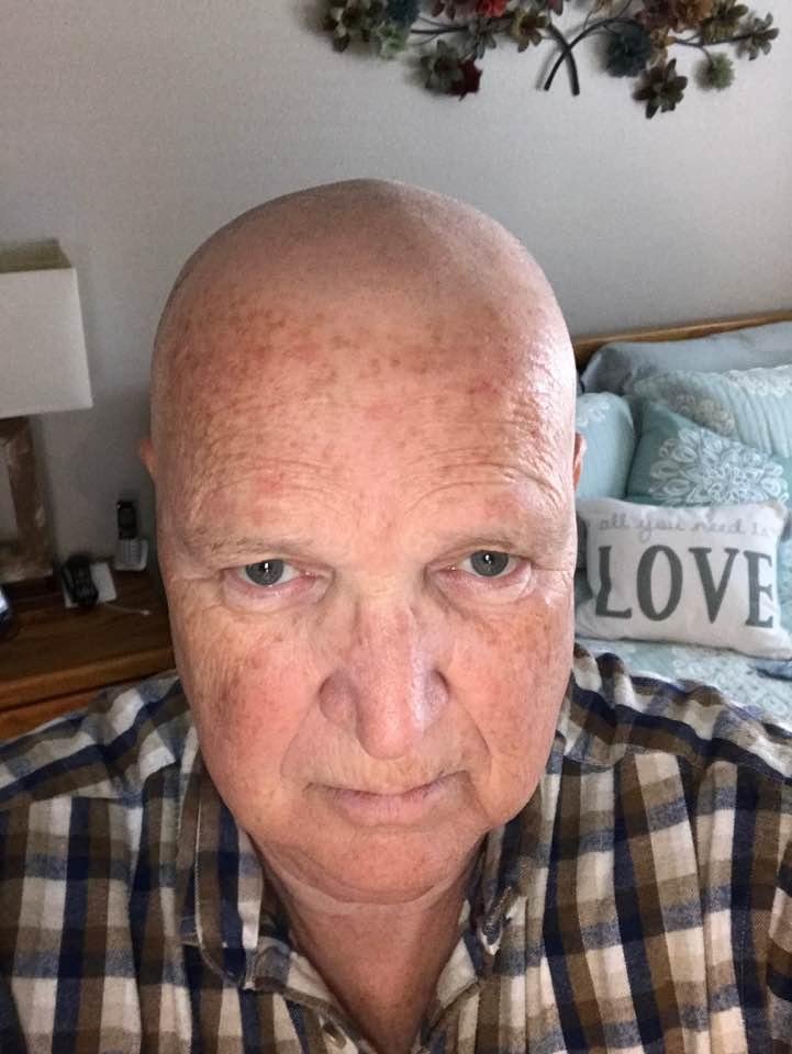 My new look after 2weeks of Chemo