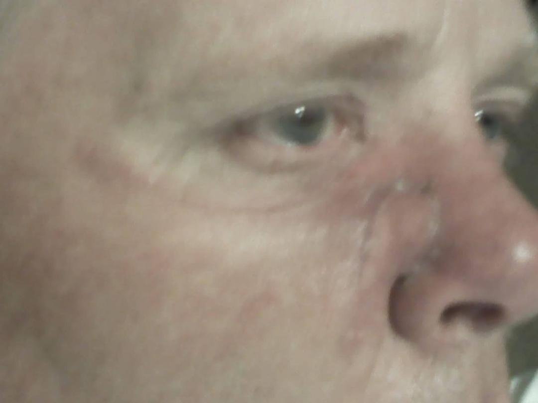 three weeks after cancer was removed