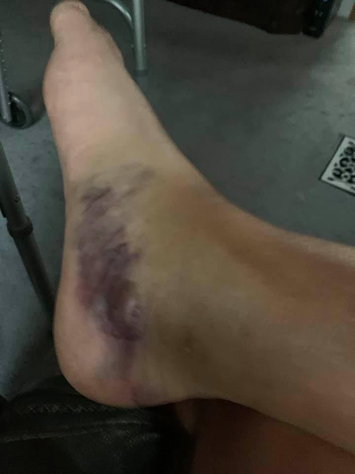 This is why old men shouldn’t get on ladders. I broke my foot yesterday. Will require surgery when swelling goes down.