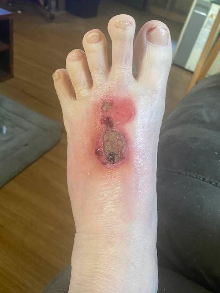 Hot water. Sucks when you spill it on your foot