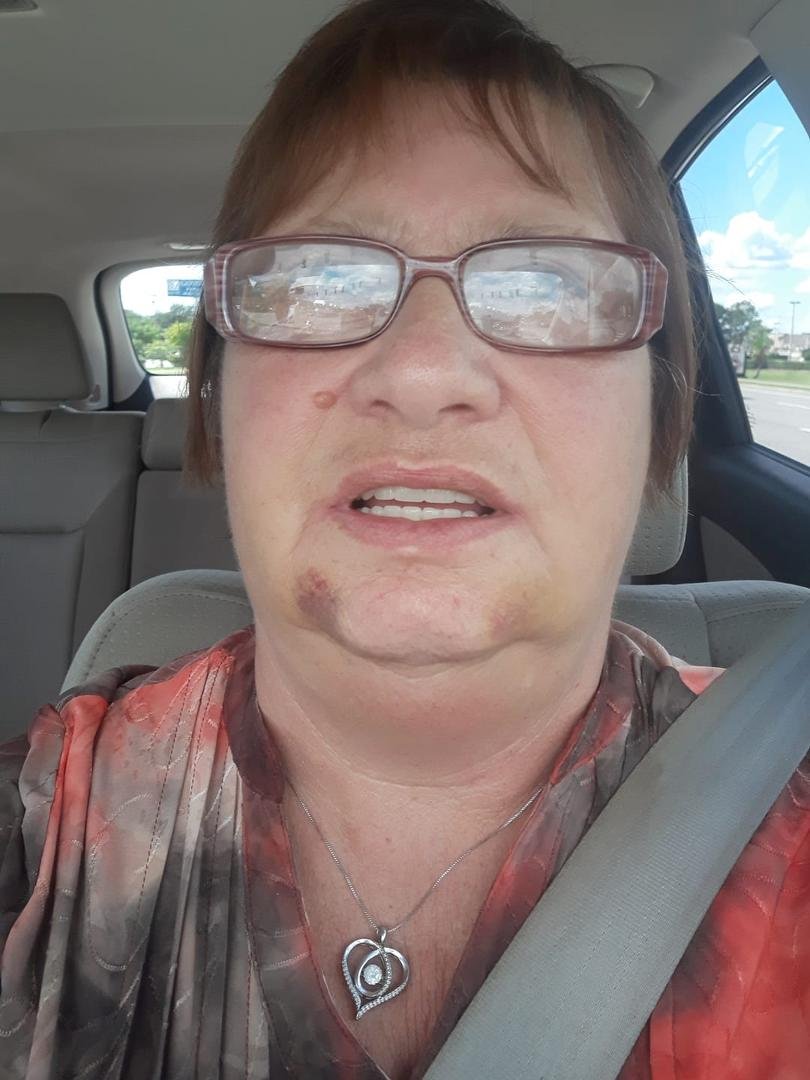 OMG .....I am in so much pain just let the dentist for a soft alignment on the bottom denture .. OUCH ... these chompers better be with it .... watch out steak here I come ( maybe) better stick with crab legs 😫😣😓