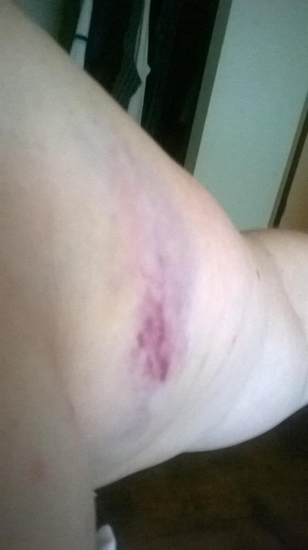 My only physical damage from the seat belt locking