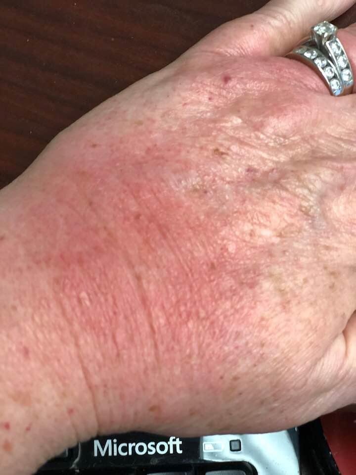 What a pain. I guess I’m allergic to Augmenton. My whole hand broke out   Ugly