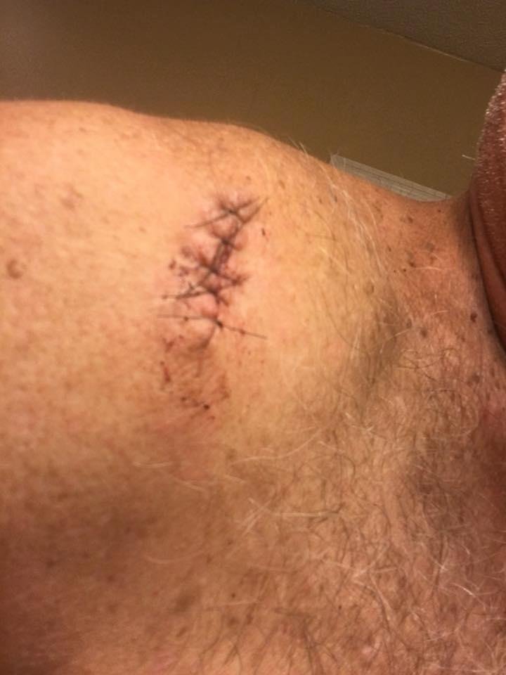 The sun is fun.... but to all the folks out there this is what you may get..1 of 3 places I had skin cancer removed...
