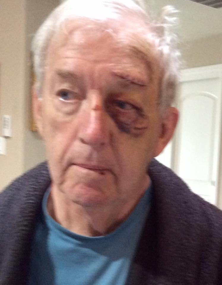 Here is John Ross 6 days after his heart attack and fall.