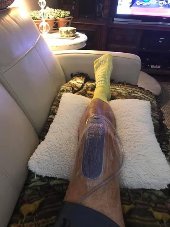 3 days post op, knee revision. That’s where they fix the broken replacement from 9 years ago. Hermetically sealed with a drain. Fun times, nice hospital socks!