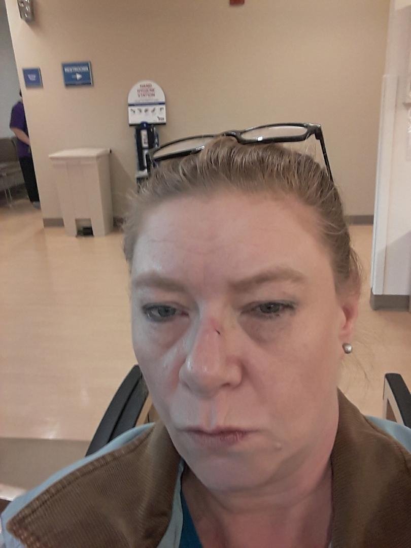 Didn't think I'd be spending my Tuesday night in the emergency room after getting head butted by my dog Bella I think my nose is broken !!!!