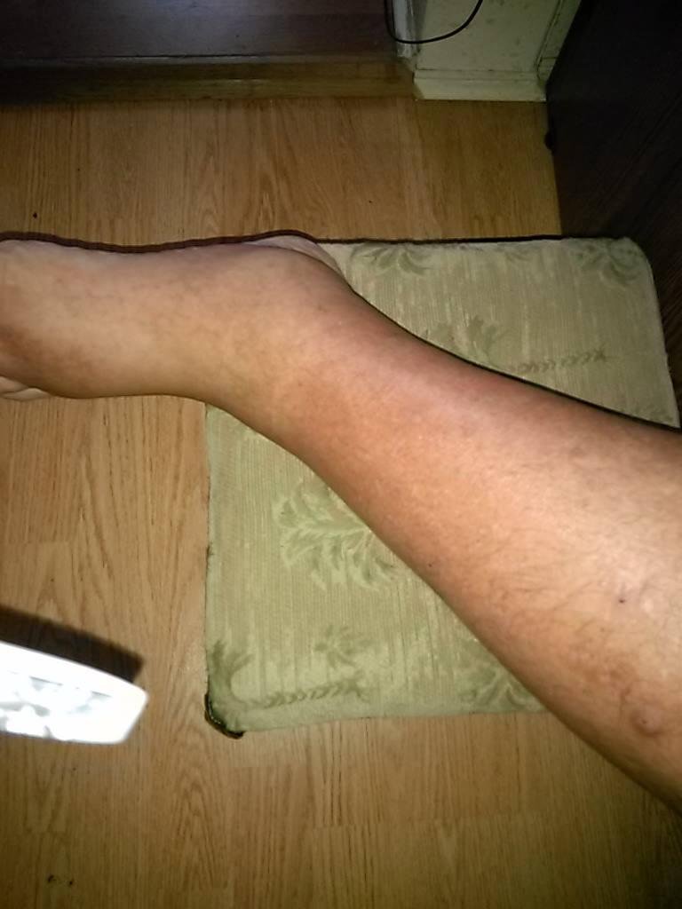 After five days of IV antibiotics and prescription medicine! My poor honey.