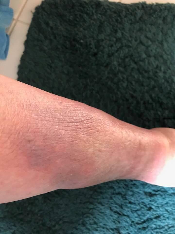 I hurt my leg a week ago and although it looks 50 percent better it still hurts! I think it is time to ask for your prayers. Thank you!