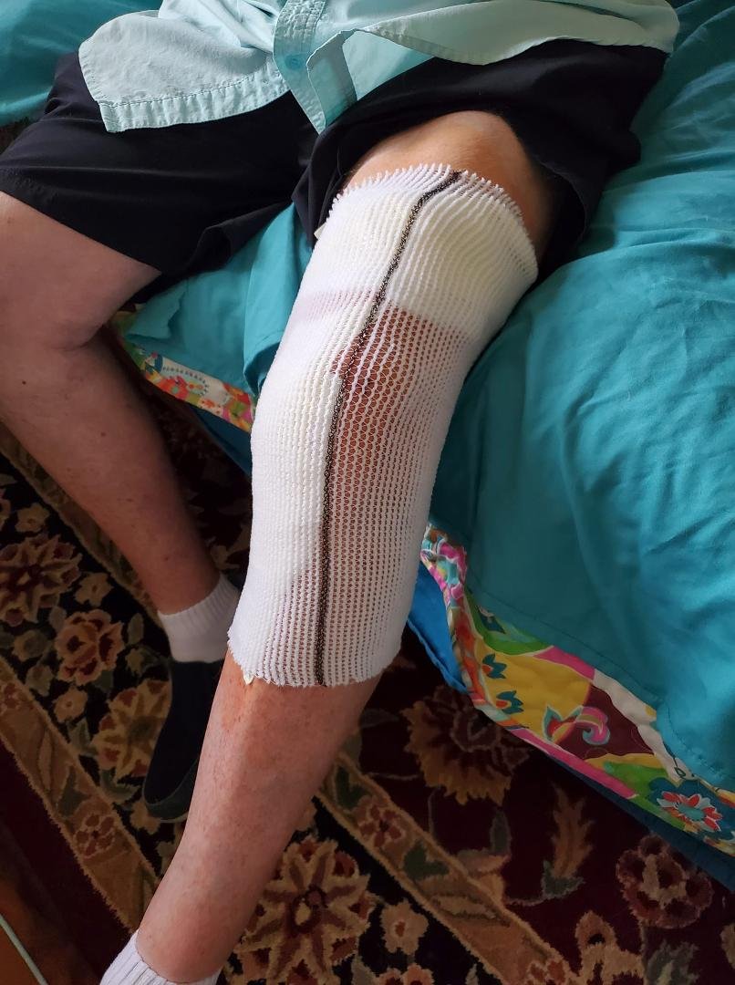 Iovera treatment done!