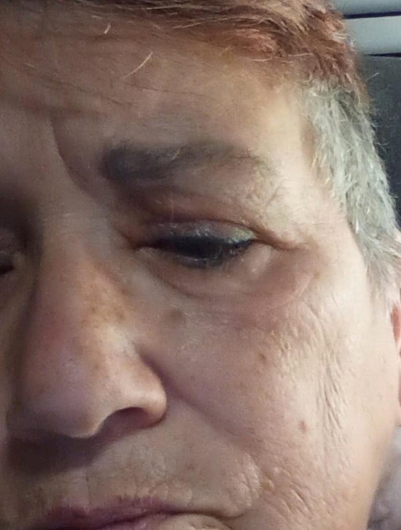 UPDATE: most of the swelling and itch are gone and I'm finding a couple of bug bites that may have caused the problem.
Last night was tough. I thought for sure I'd sleep well since I hadn't the previous night. No no no. Sw