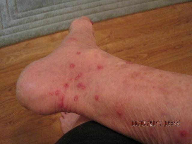 seems I stepped into some fire ants !   Thank goodness they don't bother me much !!