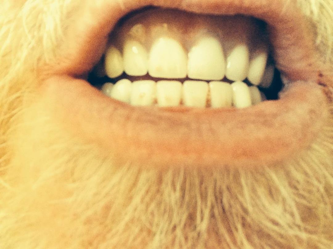 Finally done with getting my teeth fixed. What do you think?