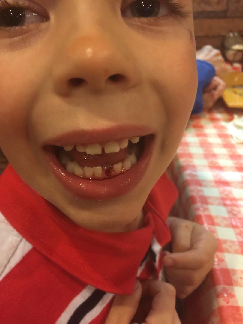 Brothers knocked out Lexi 2nd tooth today