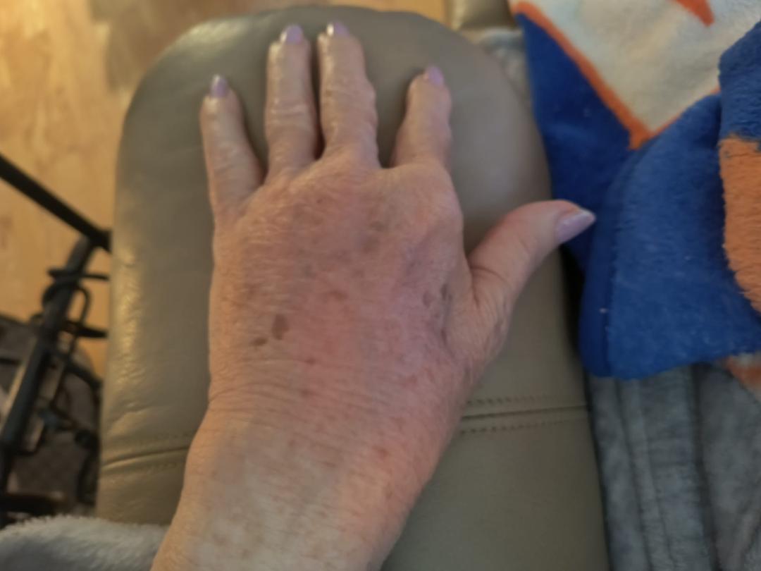 Don't know what I did to my hand but this is what it looks like right now. The doctor gave me something for inflammation and pain. Waiting on Walgreens to fill it. Boy it sure hurts.
