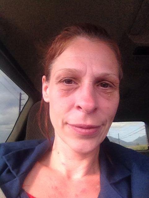 They finally approved her to get those things under her eyes removed!!!