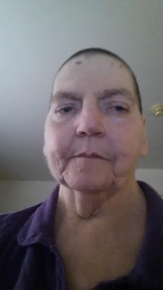 To all my Facebook friends and familythis is the new me I have been diagnosed with non-hodgkin lymphoma and will start chemo next week so I decided to get a head start on my losing my hair now I do not have to worry about b