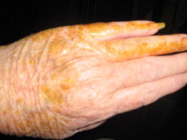 ALL WRINKLY FROM BEING WRAPPED UP. FIRST TIME THATLITTLE FINGER IS THAT STRAIGHT FOR 3 YEARS NOW!