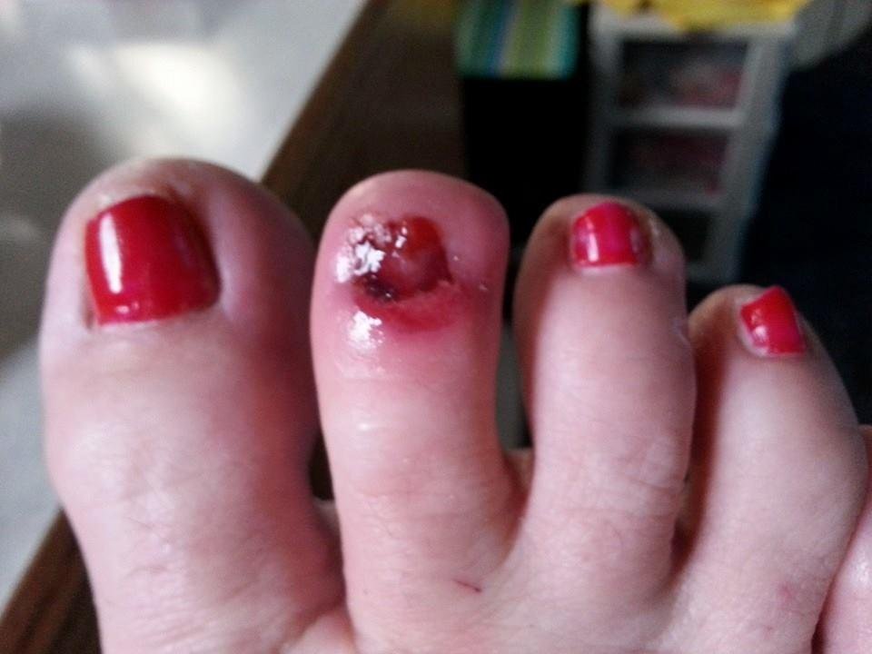 Ok i need too see what others think does this look infected ? I just called my favorite or doc and told him but he said ad long as it doesn't hurt there's no infection?