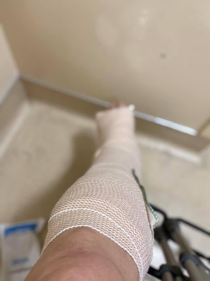 My new challenge broken ankle