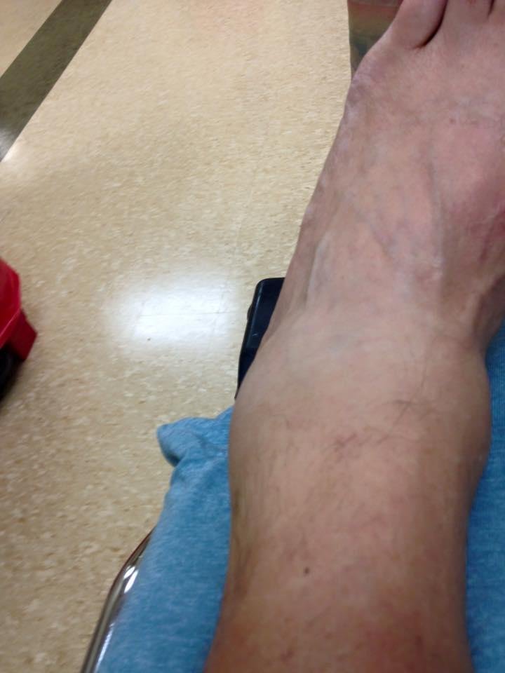 Damn do I hate crutches!!!!