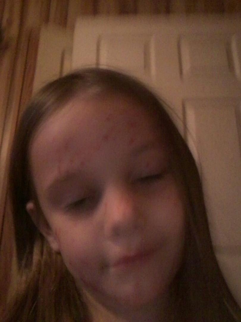 Caydence Oraczewski has chicken pox.only kidding