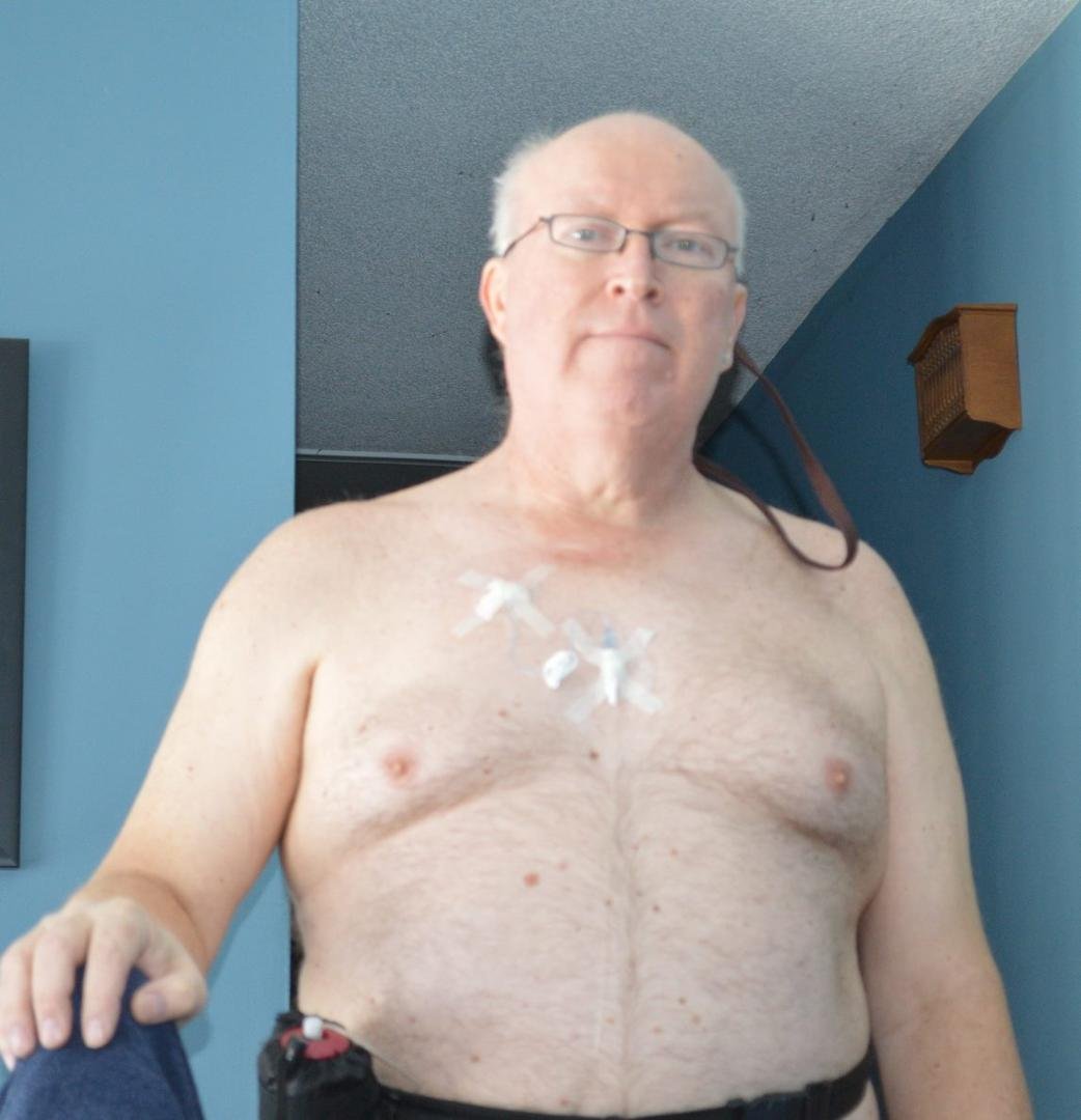 For those of you who have never seen a CHIP (Chemotherapy Home Infusion Pump) before, here is your chance. In the upper right of my chest you can see the port-a-cath under the skin. It is a silicone and metal drum with a li