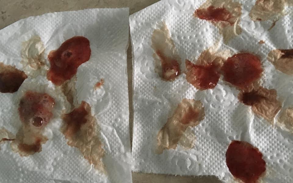 This is what fragrances (perfumes, deodorants, hairsprays, room fresheners, household cleaners etc) end up doing to my lungs. Every morning, I spend an hour or more coughing this junk up out of my lungs. Even then I cannot 