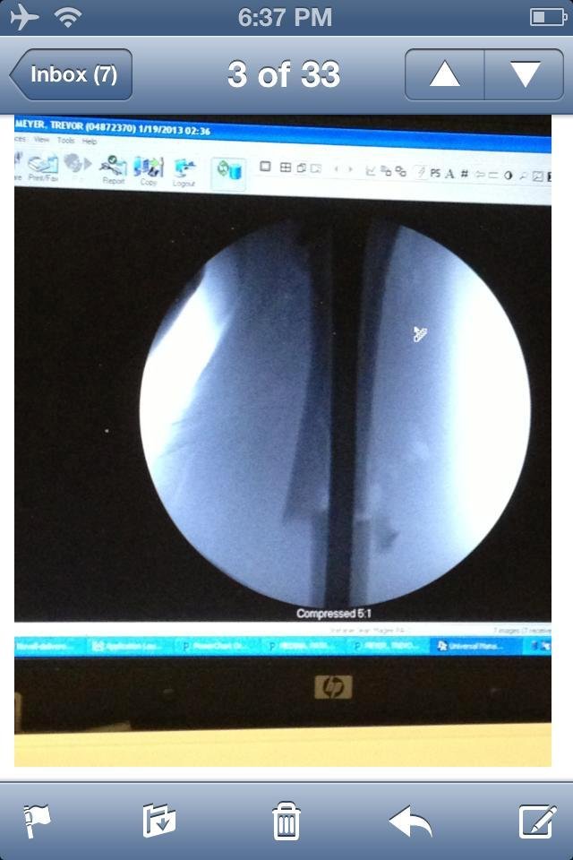 This is my sons leg after 2+1/2 hours of surgery Saturday morning. Nice rod down the bone. There goes his Bogus ski pass, soccer and mtn. Biking for 3 months!