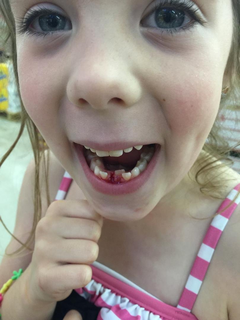 Brothers knocked out Lexi 2nd tooth today