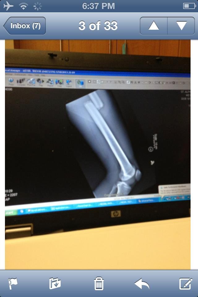 This is my sons femur after his sledding accident Friday night.