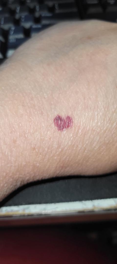 Hit a minor bump with a metal tray yesterday and look at my small badge of honor, a little heart 💕 bruise. 💪🏼😊👍