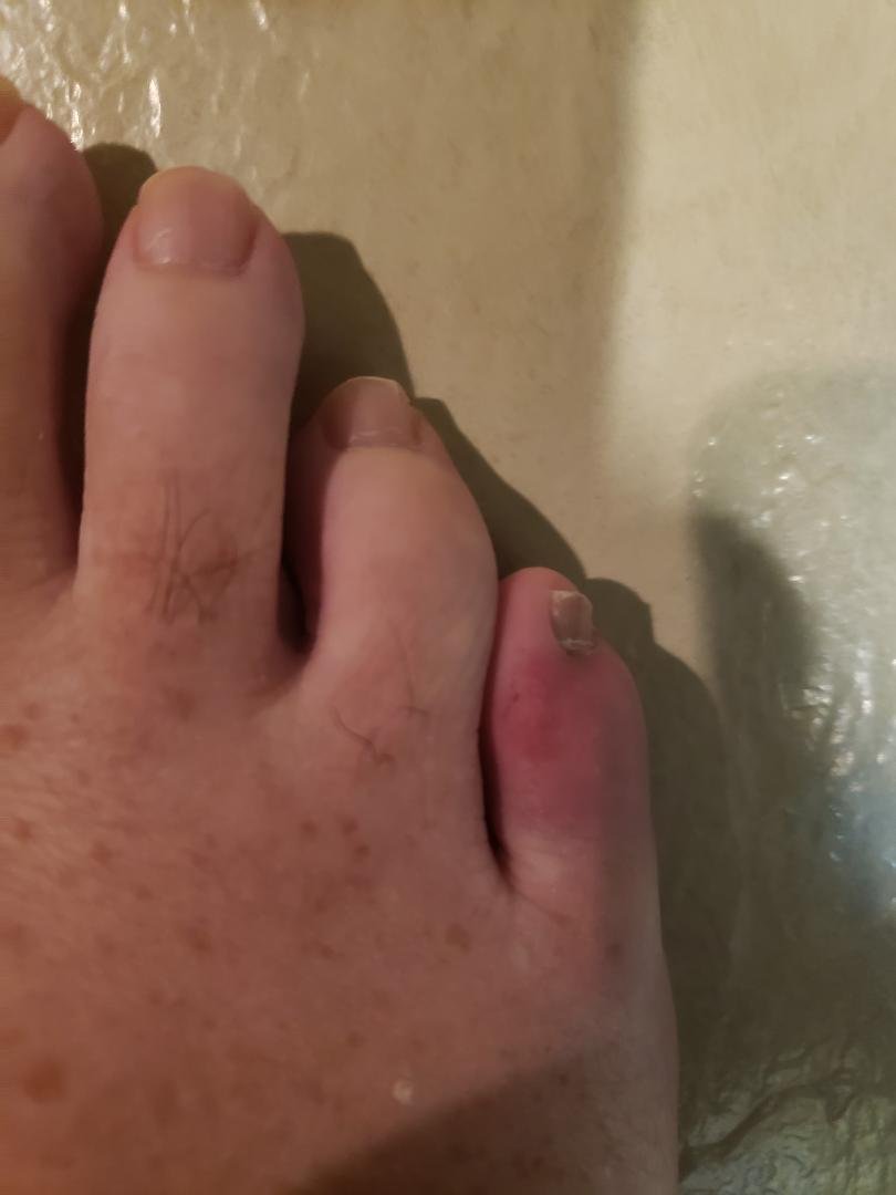 Are you serious? I broke the same toe again??? Yep.