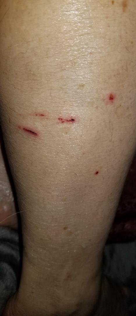 This is what happens when you can't feel your legs..I kept walking by a box and thinking..darn that cardboard is really poking me..nope there was a knife in there and it was sticking out and every time I walked by..it was s
