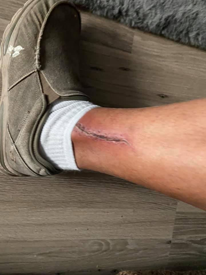 Stitches are out
