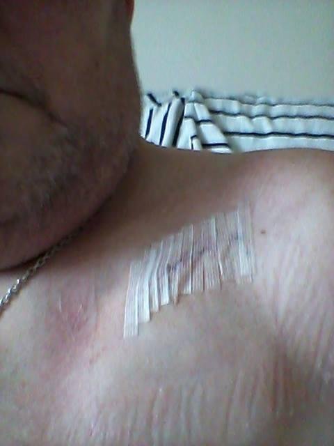 Starting to heal up rightly