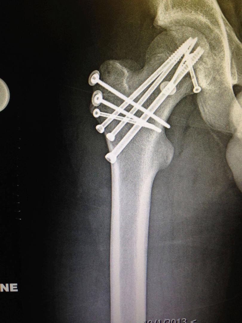 Owen's hip after surgery