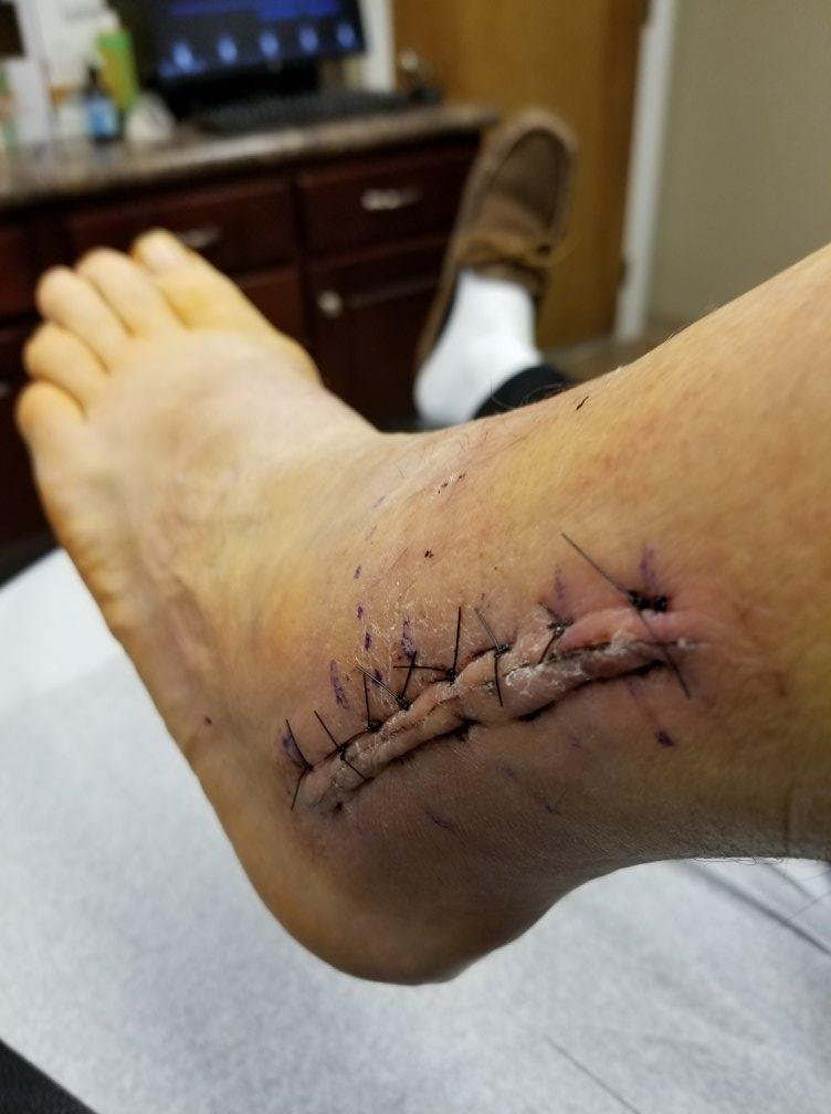 outside of left ankle   stitches out next week now