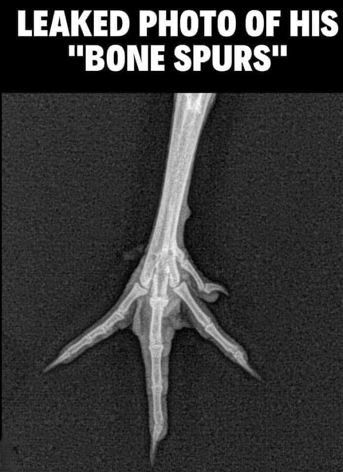Breaking news. Photos of trump’s bone spurs!!!