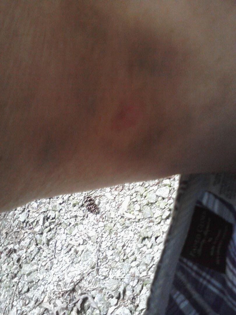 my spider bit on my inside thigh by the "run like hell" spider Steve Guidero